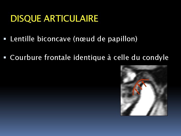 DISQUE ARTICULAIRE Lentille biconcave (nœud de papillon) Courbure frontale identique à celle du condyle