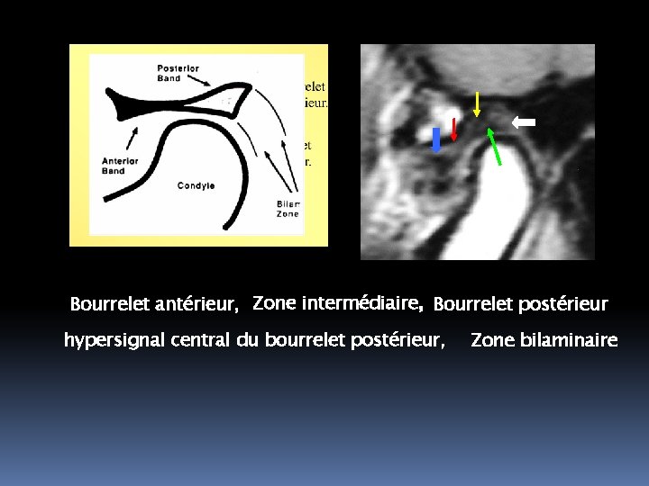 Bourrelet antérieur, Zone intermédiaire, Bourrelet postérieur hypersignal central du bourrelet postérieur, Zone bilaminaire 