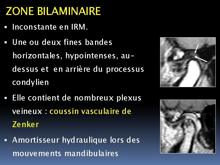 ZONE BILAMINAIRE Inconstante en IRM. Une ou deux fines bandes horizontales, hypointenses, audessus et