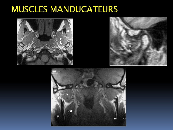 MUSCLES MANDUCATEURS T PM M P L P L T P L PM M