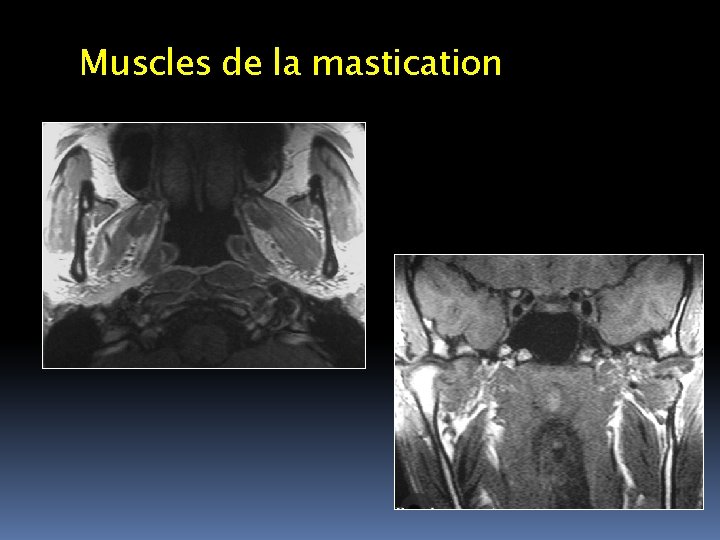 Muscles de la mastication 