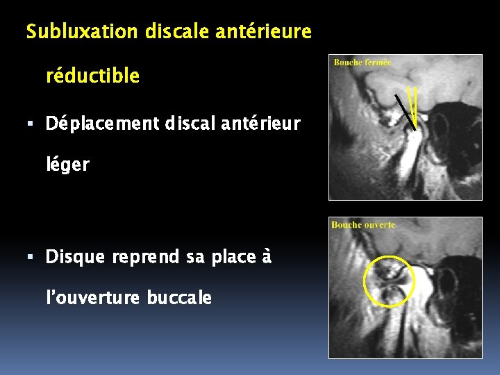 Subluxation discale antérieure réductible Déplacement discal antérieur léger Disque reprend sa place à l’ouverture