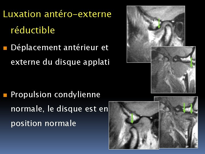 Luxation antéro-externe réductible n Déplacement antérieur et externe du disque applati n Propulsion condylienne