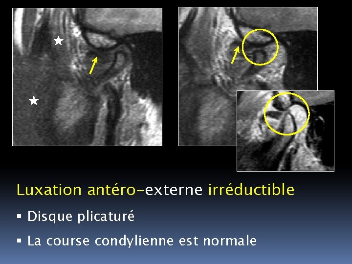 Luxation antéro-externe irréductible Disque plicaturé La course condylienne est normale 