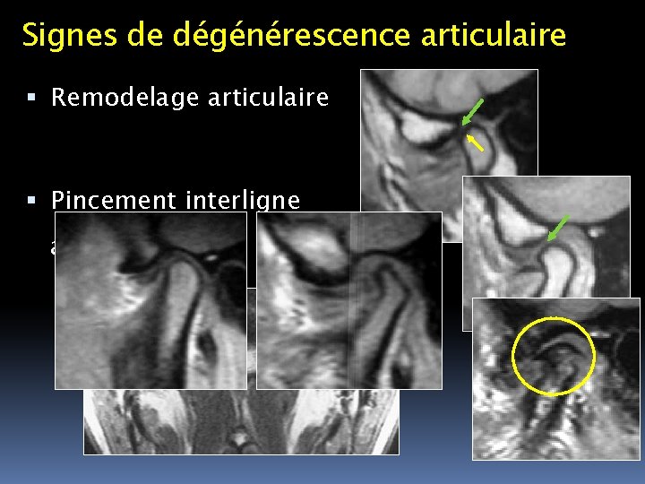 Signes de dégénérescence articulaire Remodelage articulaire Pincement interligne articulaire 