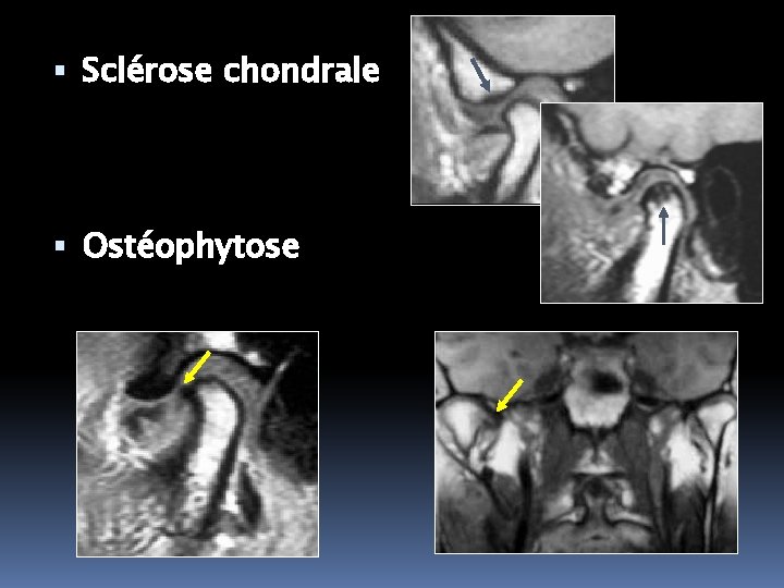  Sclérose chondrale Ostéophytose 