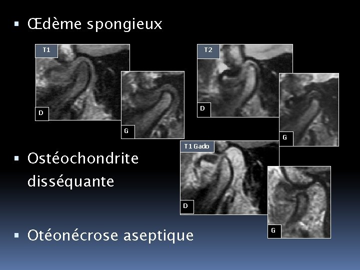  Œdème spongieux T 2 T 1 D D G Ostéochondrite G T 1