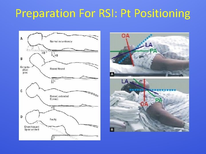 Preparation For RSI: Pt Positioning 