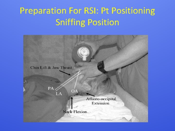 Preparation For RSI: Pt Positioning Sniffing Position 