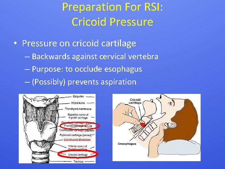 Preparation For RSI: Cricoid Pressure • Pressure on cricoid cartilage – Backwards against cervical