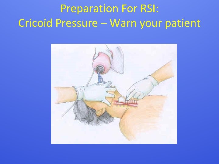 Preparation For RSI: Cricoid Pressure – Warn your patient 