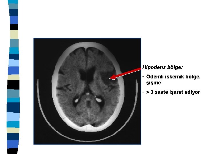 Hipodens bölge: • Ödemli iskemik bölge, şişme • > 3 saate işaret ediyor 