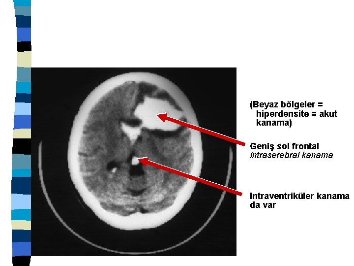 (Beyaz bölgeler = hiperdensite = akut kanama) Geniş sol frontal intraserebral kanama Intraventriküler kanama