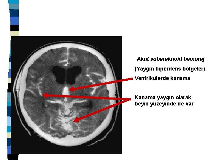 Akut subaraknoid hemoraj (Yaygın hiperdens bölgeler) Ventrikülerde kanama Kanama yaygın olarak beyin yüzeyinde de