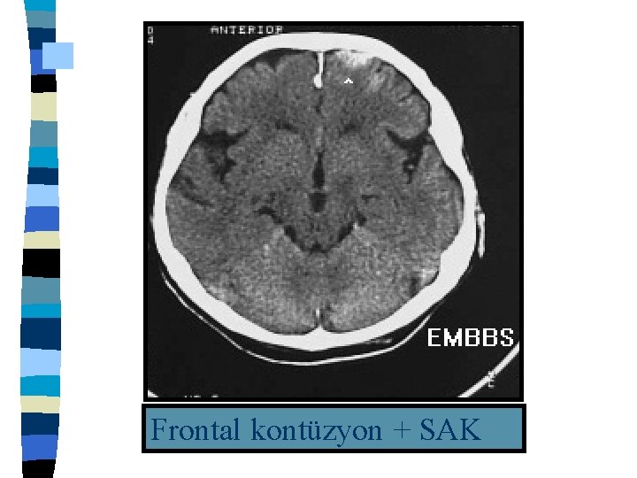 Frontal kontüzyon + SAK 