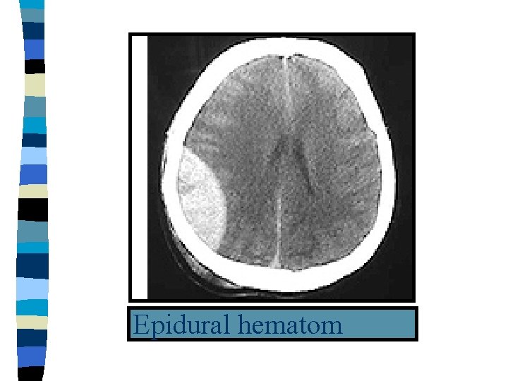 Epidural hematom 