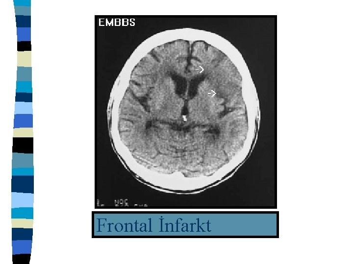 Frontal İnfarkt 