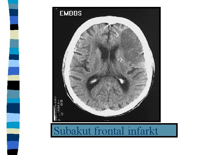 Subakut frontal infarkt 