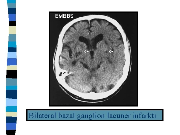 Bilateral bazal ganglion lacuner infarktı 