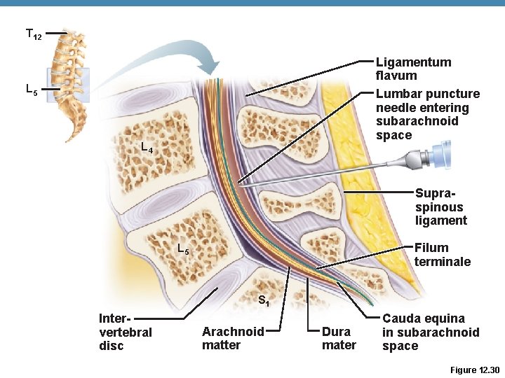 T 12 Ligamentum flavum Lumbar puncture needle entering subarachnoid space L 5 L 4