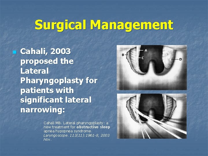 Surgical Management n Cahali, 2003 proposed the Lateral Pharyngoplasty for patients with significant lateral