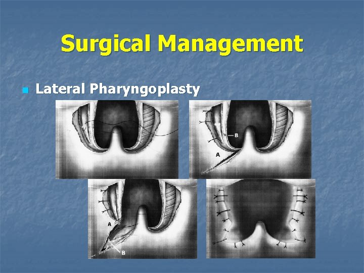 Surgical Management n Lateral Pharyngoplasty 