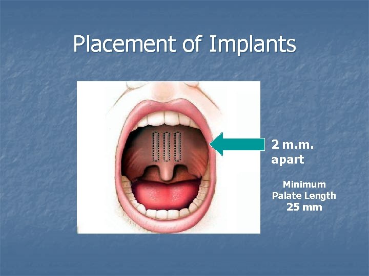 Placement of Implants 2 m. m. apart Minimum Palate Length 25 mm 