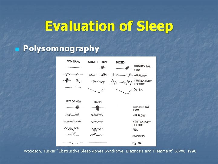 Evaluation of Sleep n Polysomnography Woodson, Tucker “Obstructive Sleep Apnea Syndrome, Diagnosis and Treatment”