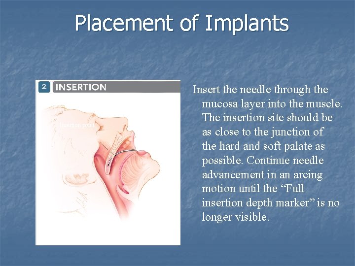 Placement of Implants Insertion point Insert the needle through the mucosa layer into the