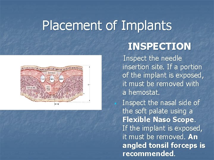 Placement of Implants INSPECTION Hard palate Muscle Implant Glandular tissue § Inspect the needle