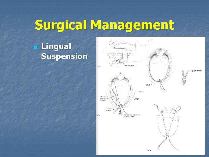 Surgical Management n Lingual Suspension 