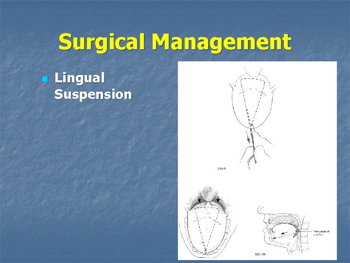 Surgical Management n Lingual Suspension 
