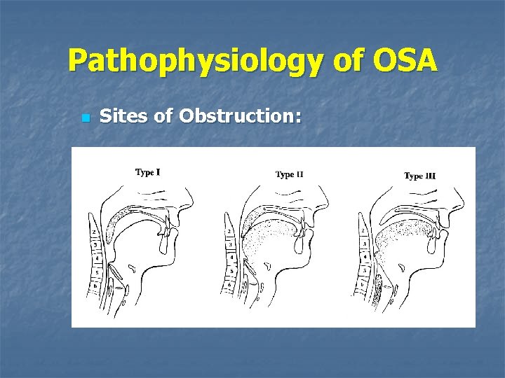 Pathophysiology of OSA n Sites of Obstruction: 