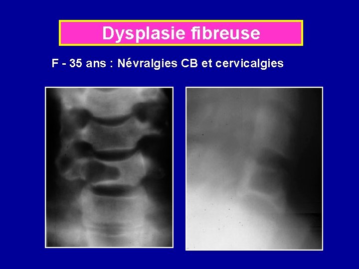 Dysplasie fibreuse F - 35 ans : Névralgies CB et cervicalgies 