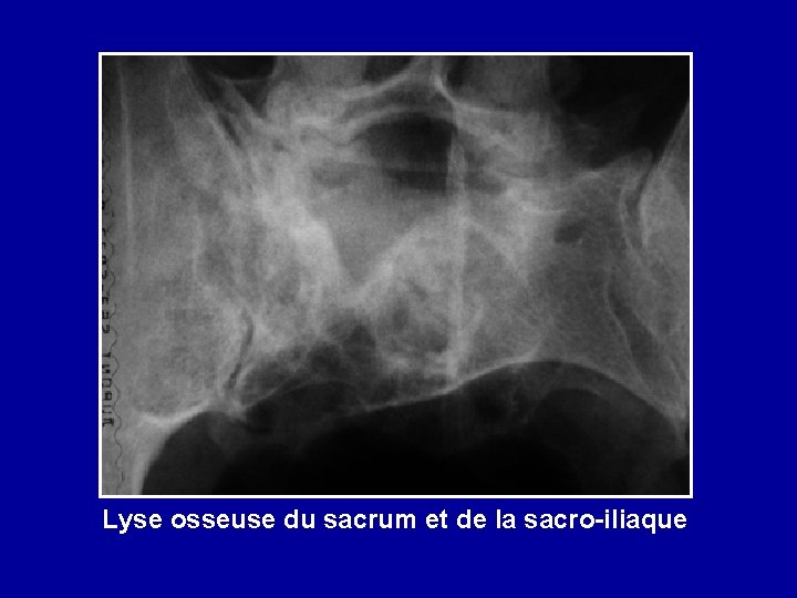 Lyse osseuse du sacrum et de la sacro-iliaque 