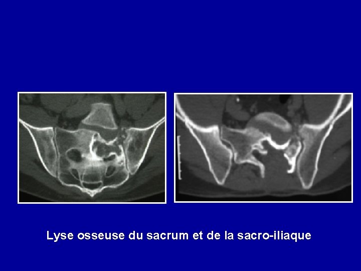Lyse osseuse du sacrum et de la sacro-iliaque 