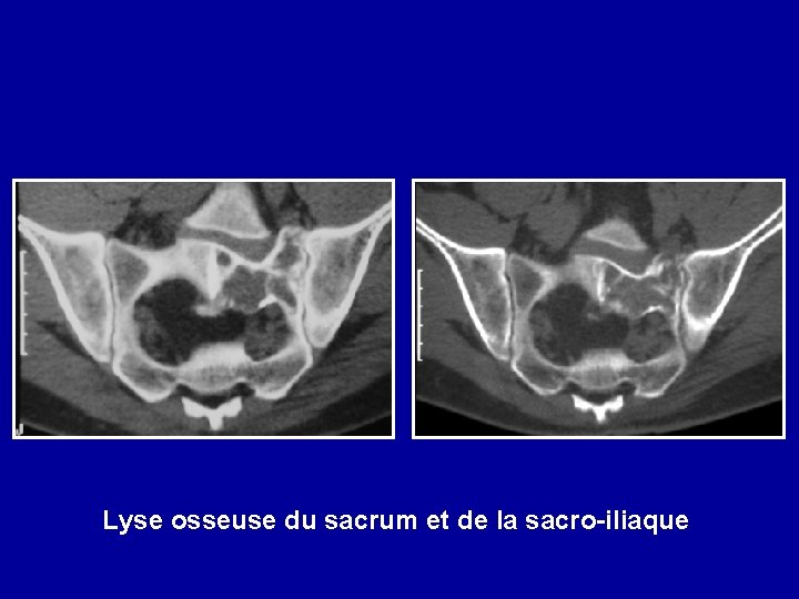 Lyse osseuse du sacrum et de la sacro-iliaque 