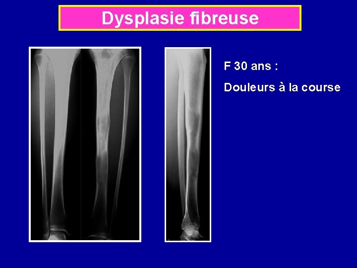 Dysplasie fibreuse F 30 ans : Douleurs à la course 