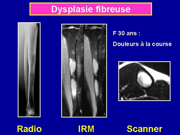 Dysplasie fibreuse F 30 ans : Douleurs à la course Radio IRM Scanner 