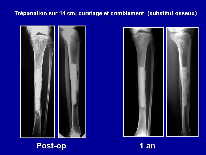 Trépanation sur 14 cm, curetage et comblement (substitut osseux) Post-op 1 an 