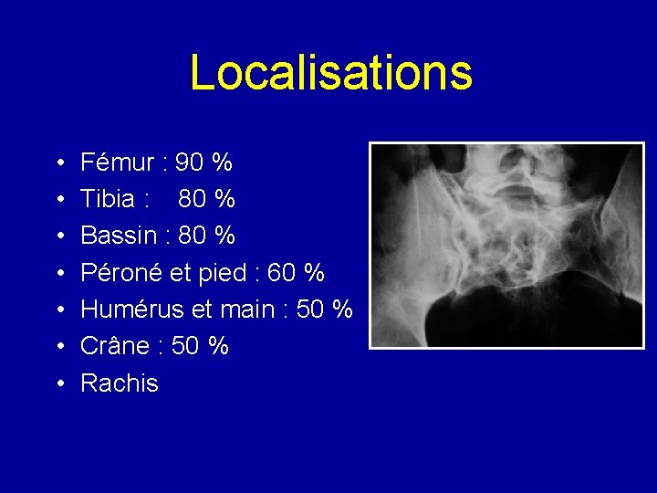 Localisations • • Fémur : 90 % Tibia : 80 % Bassin : 80