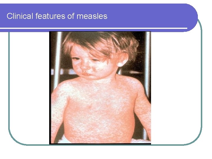 Clinical features of measles Clinical features of measles