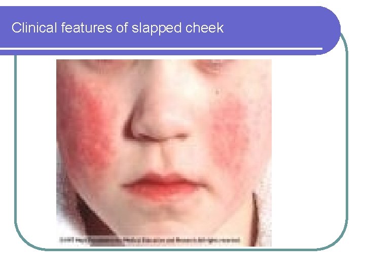 Clinical features of slapped cheek Clinical features of slapped cheek