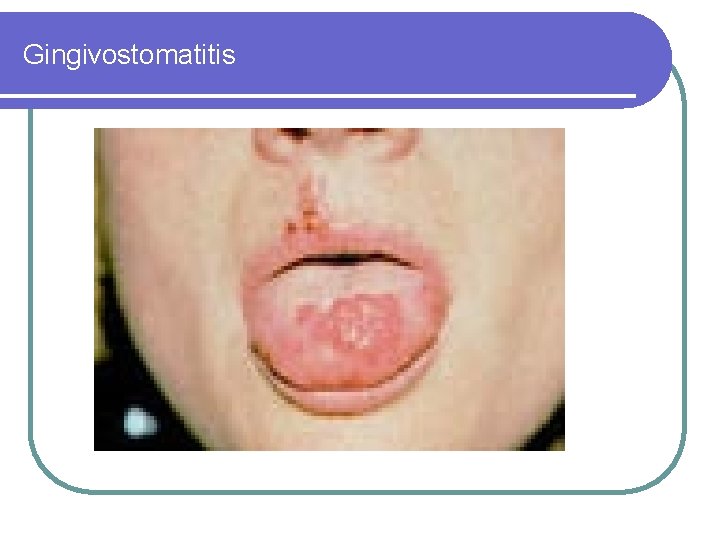 Gingivostomatitis Gingivostomatitis