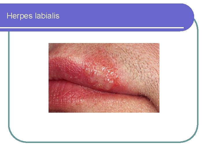 Herpes labialis Herpes labialis