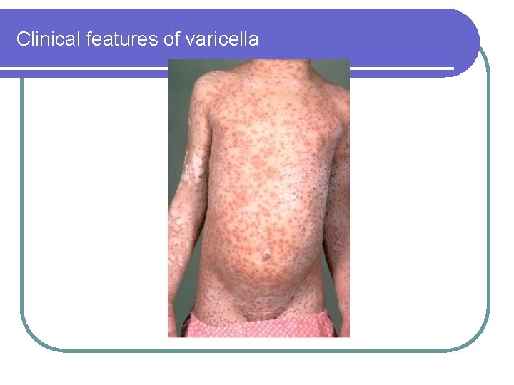 Clinical features of varicella Clinical features of varicella
