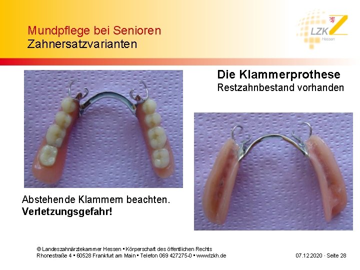 Mundpflege bei Senioren Zahnersatzvarianten Die Klammerprothese Restzahnbestand vorhanden Abstehende Klammern beachten. Verletzungsgefahr! © Landeszahnärztekammer