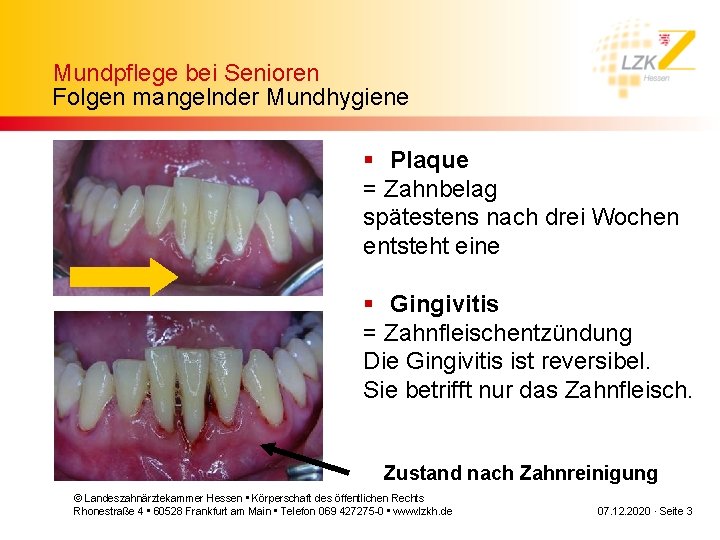 Mundpflege bei Senioren Folgen mangelnder Mundhygiene § Plaque = Zahnbelag spätestens nach drei Wochen