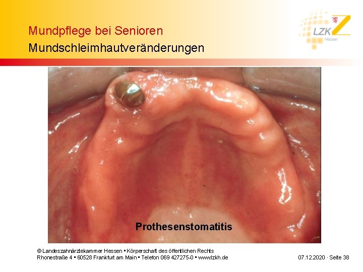 Mundpflege bei Senioren Mundschleimhautveränderungen Prothesenstomatitis © Landeszahnärztekammer Hessen • Körperschaft des öffentlichen Rechts Rhonestraße