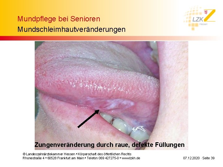 Mundpflege bei Senioren Mundschleimhautveränderungen Zungenveränderung durch raue, defekte Füllungen © Landeszahnärztekammer Hessen • Körperschaft